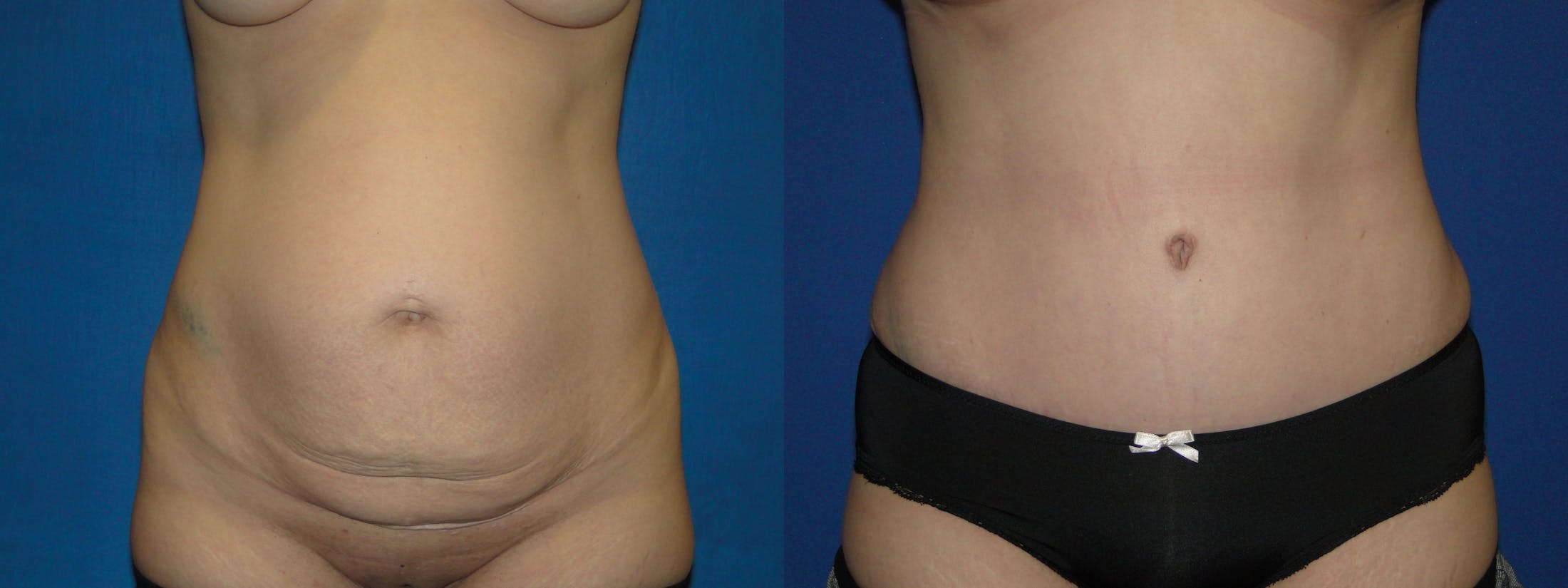 Tummy Tuck Gallery - Patient 74866195 - Image 1