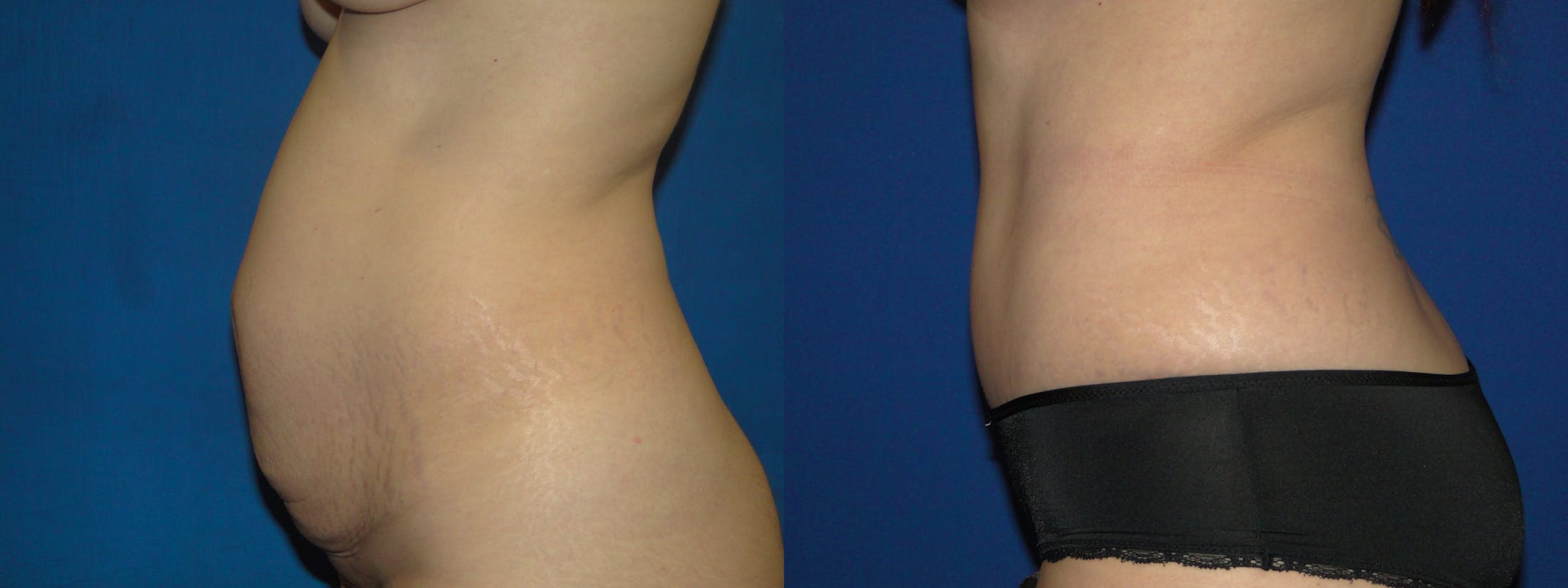 Tummy Tuck Before & After Gallery - Patient 74866195 - Image 2