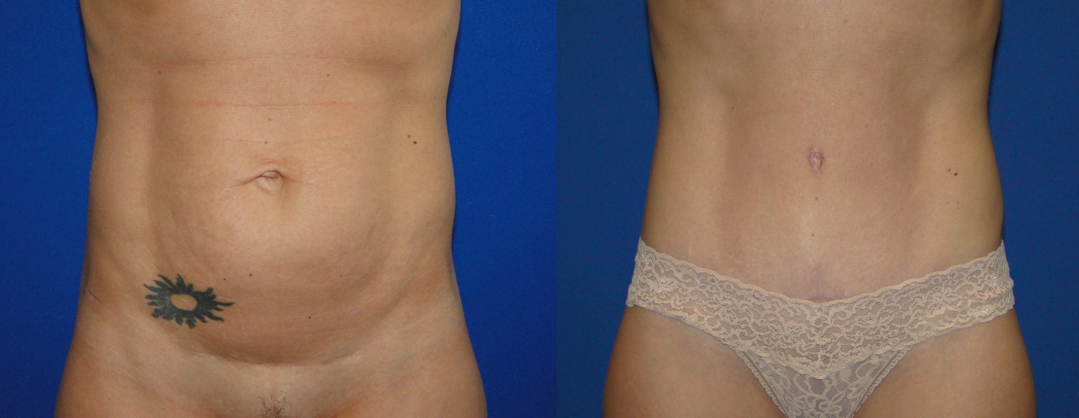 Tummy Tuck Gallery - Patient 74866196 - Image 1