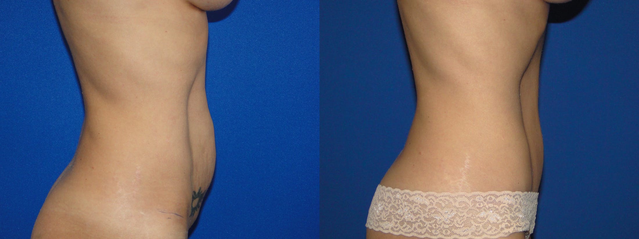 Tummy Tuck Before & After Gallery - Patient 74866196 - Image 2