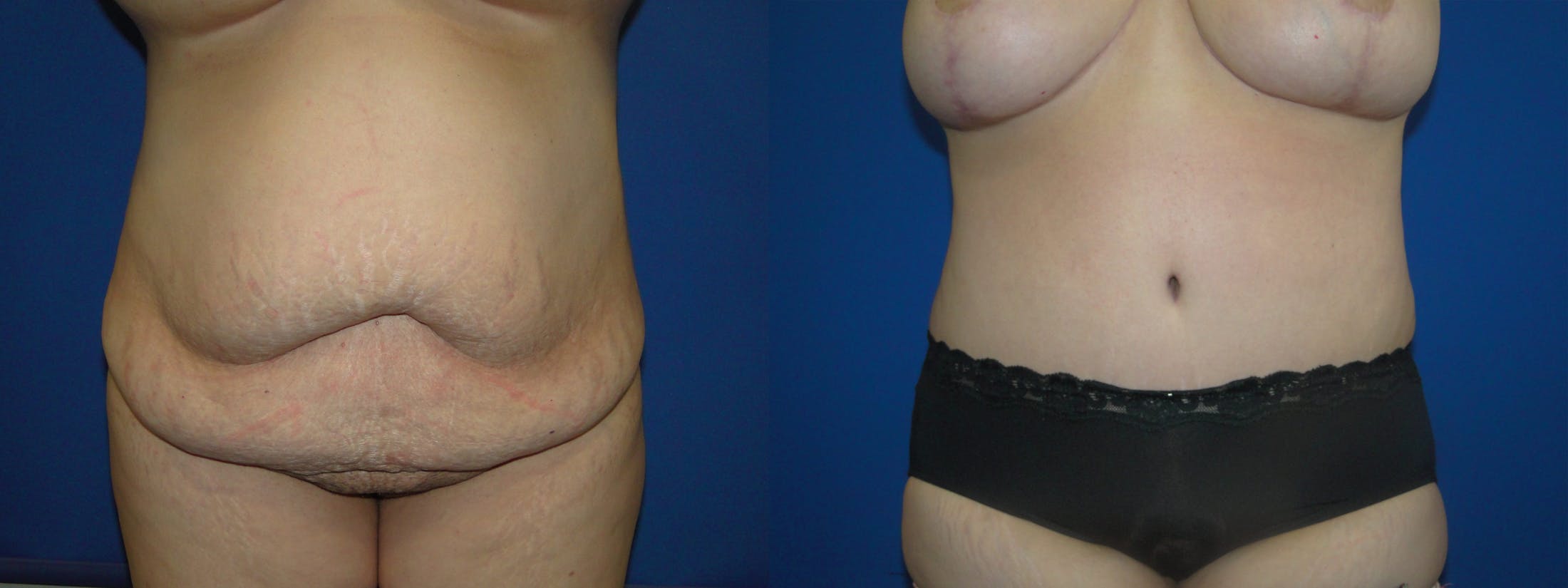 Tummy Tuck Gallery - Patient 74866197 - Image 1