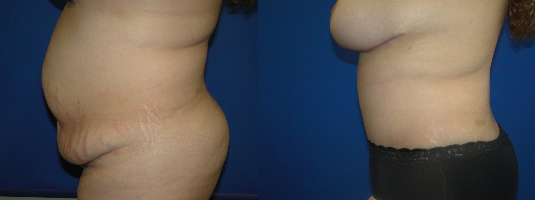 Tummy Tuck Before & After Gallery - Patient 74866197 - Image 2