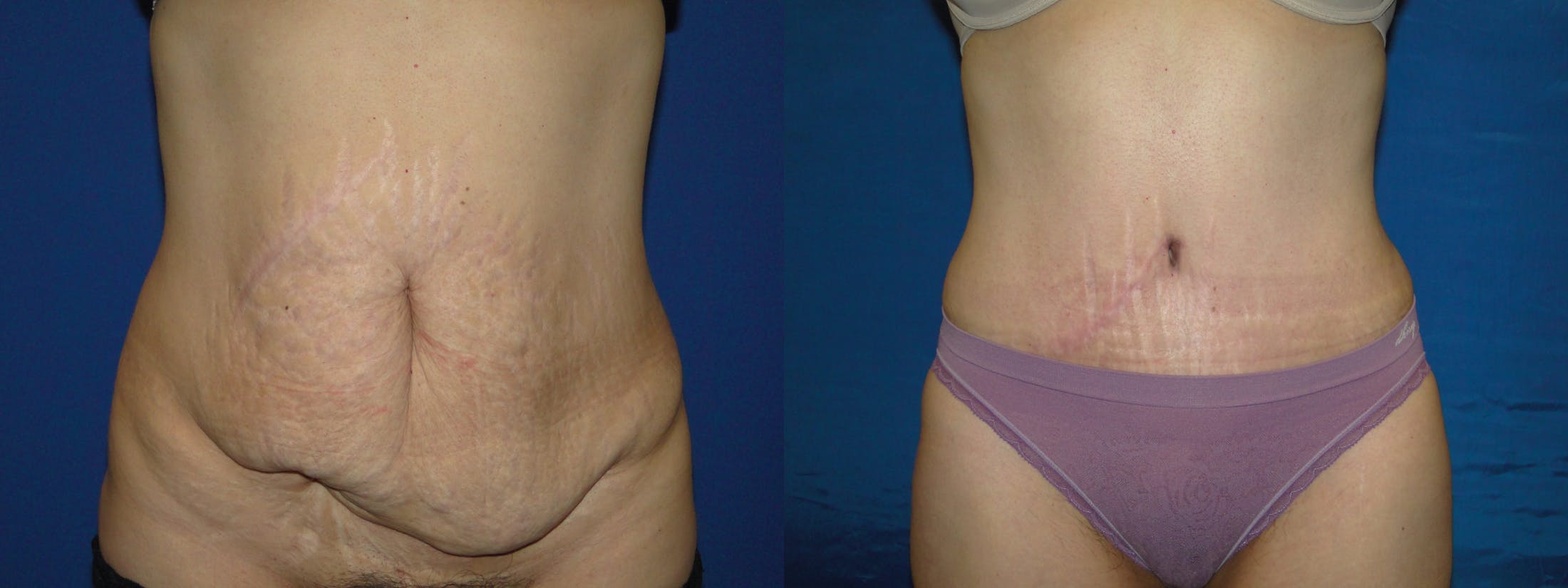 Tummy Tuck Gallery - Patient 74866200 - Image 1