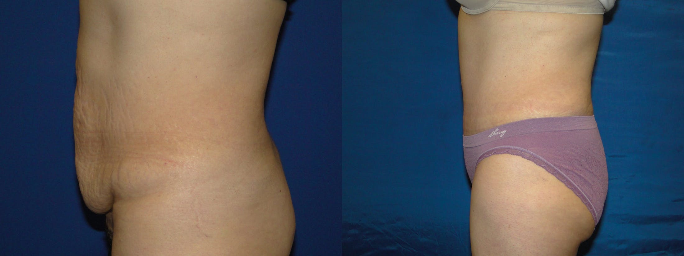 Tummy Tuck Before & After Gallery - Patient 74866200 - Image 2