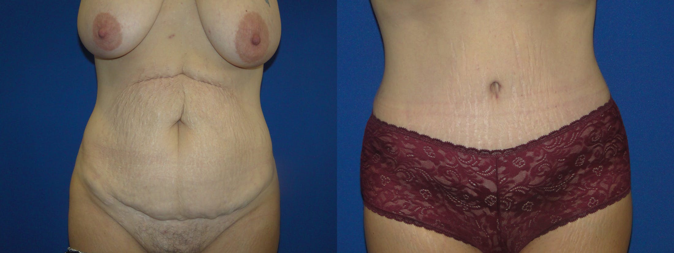 Tummy Tuck Gallery - Patient 74866202 - Image 1
