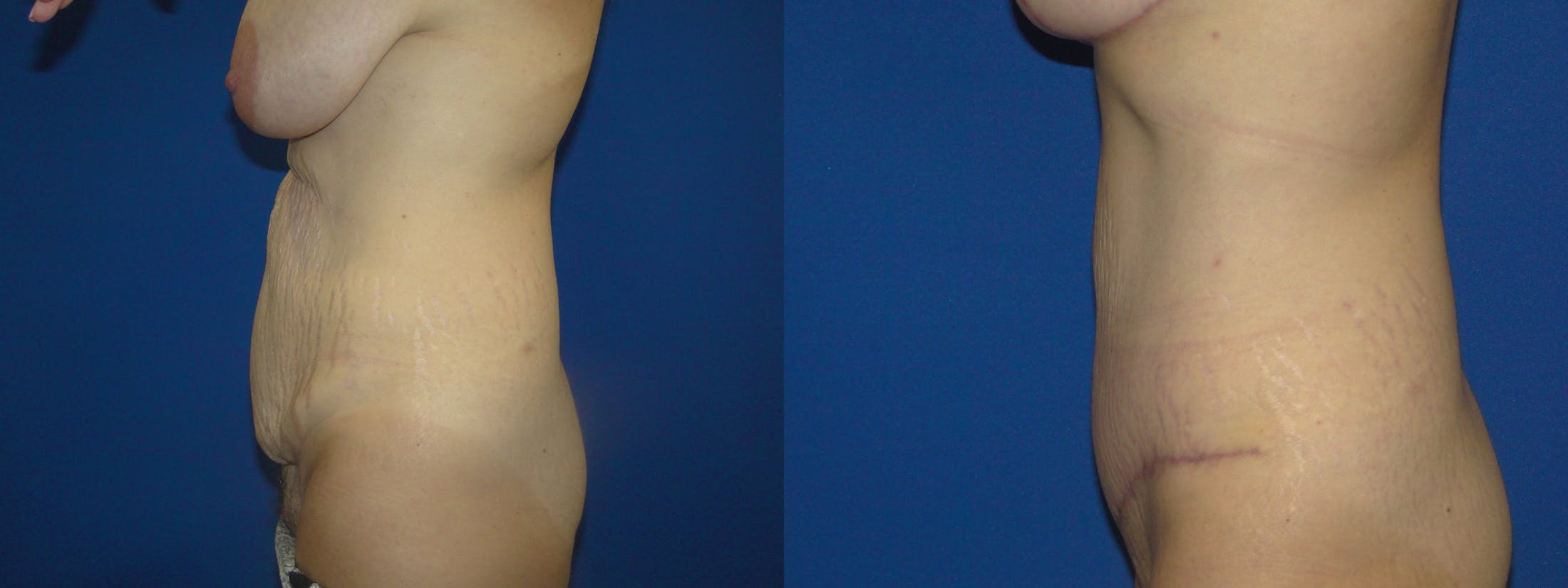 Tummy Tuck Before & After Gallery - Patient 74866202 - Image 2
