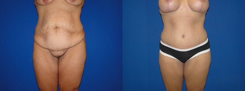 Tummy Tuck Before & After Gallery - Patient 74866204 - Image 1