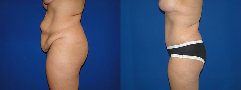 Tummy Tuck Before & After Gallery - Patient 74866204 - Image 2