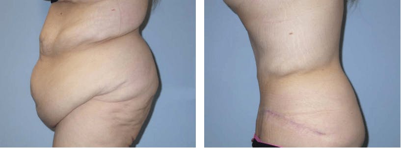 Tummy Tuck Before & After Gallery - Patient 74866356 - Image 1