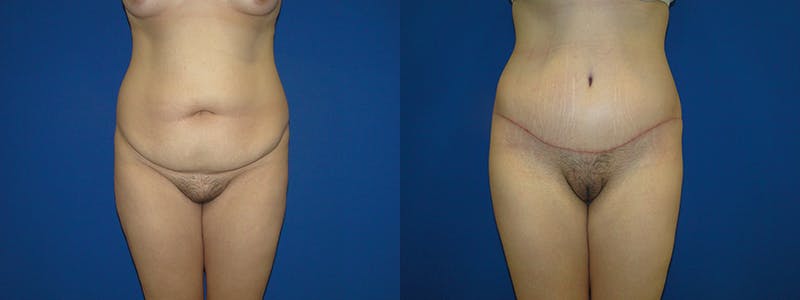 Tummy Tuck Before & After Gallery - Patient 74866361 - Image 1