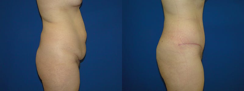 Tummy Tuck Before & After Gallery - Patient 74866361 - Image 2