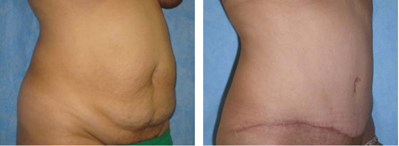 Tummy Tuck Before & After Gallery - Patient 74866368 - Image 1
