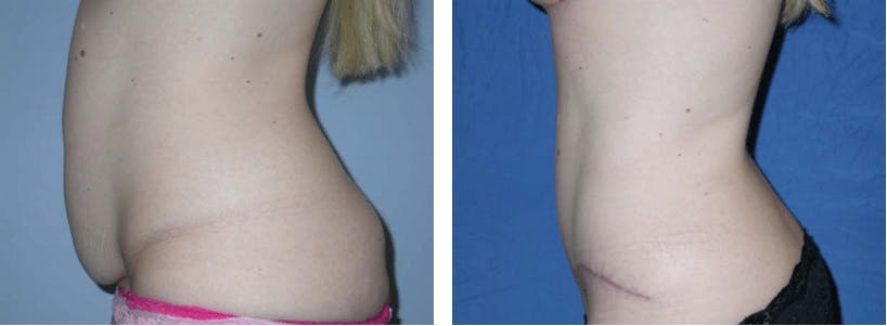 Tummy Tuck Before & After Gallery - Patient 74866369 - Image 2