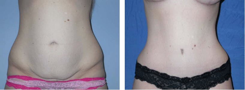 Tummy Tuck Before & After Gallery - Patient 74866369 - Image 1