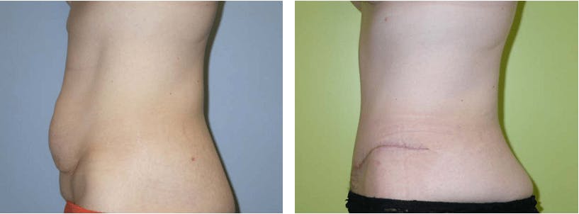 Tummy Tuck Before & After Gallery - Patient 74866372 - Image 1