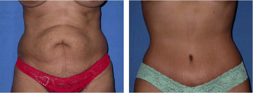 Tummy Tuck Before & After Gallery - Patient 74866374 - Image 1