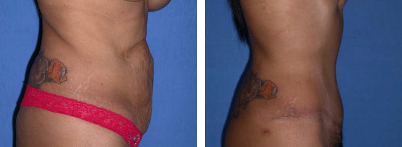 Tummy Tuck Before & After Gallery - Patient 74866374 - Image 2