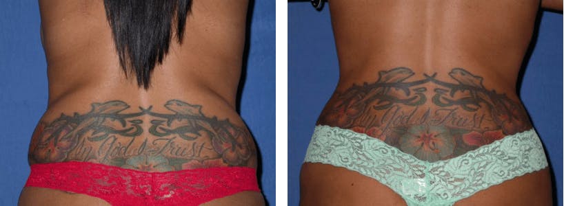 Tummy Tuck Before & After Gallery - Patient 74866374 - Image 3