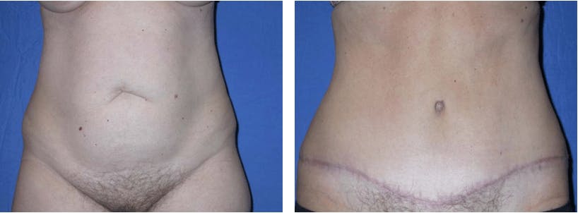 Tummy Tuck Before & After Gallery - Patient 74866375 - Image 1
