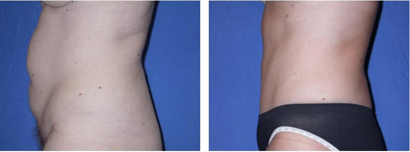 Tummy Tuck Before & After Gallery - Patient 74866375 - Image 2