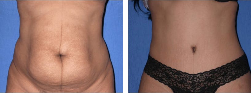 Tummy Tuck Before & After Gallery - Patient 74866378 - Image 1