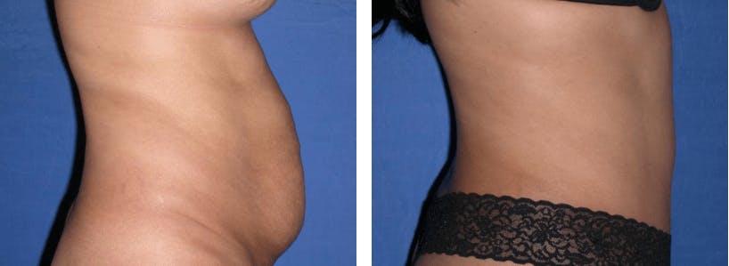 Tummy Tuck Before & After Gallery - Patient 74866378 - Image 2