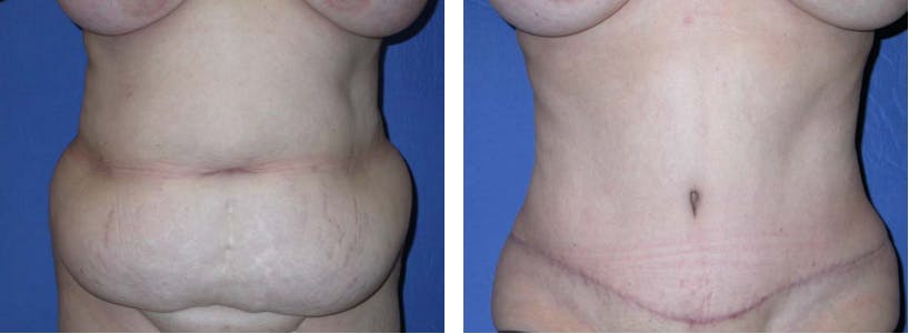 Tummy Tuck Before & After Gallery - Patient 74866379 - Image 1
