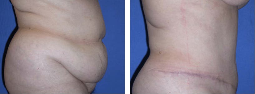 Tummy Tuck Before & After Gallery - Patient 74866379 - Image 2