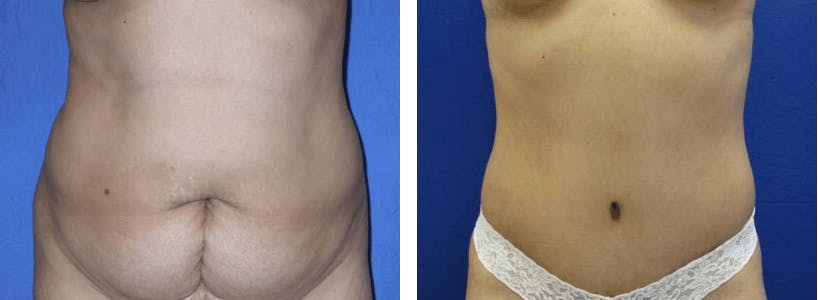 Tummy Tuck Before & After Gallery - Patient 74866380 - Image 1