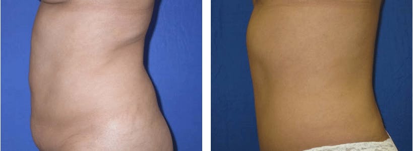 Tummy Tuck Before & After Gallery - Patient 74866380 - Image 2