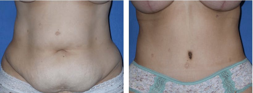 Tummy Tuck Before & After Gallery - Patient 74866381 - Image 1
