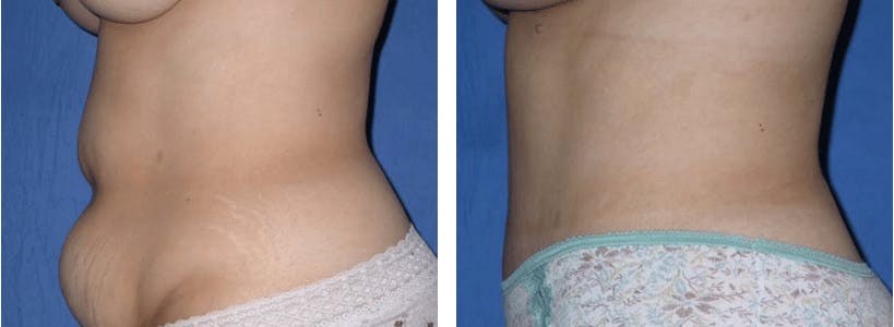 Tummy Tuck Before & After Gallery - Patient 74866381 - Image 2