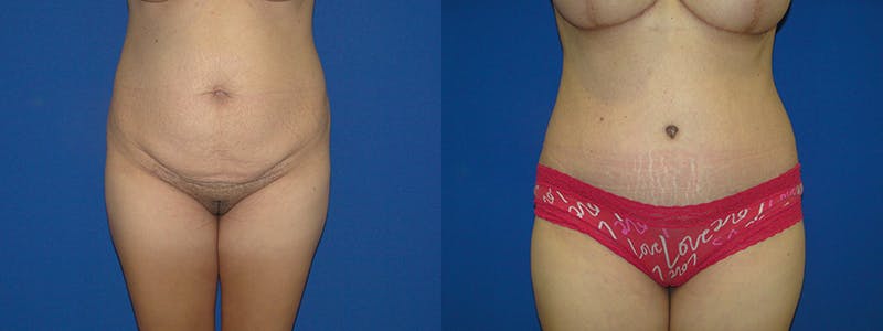Tummy Tuck Before & After Gallery - Patient 74866382 - Image 1