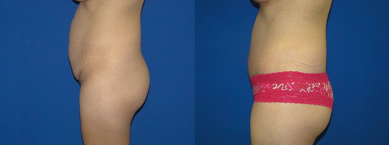 Tummy Tuck Gallery - Patient 74866382 - Image 2