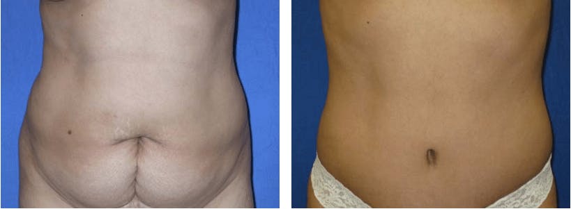 Tummy Tuck Before & After Gallery - Patient 74866383 - Image 1