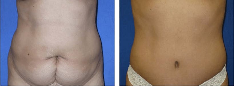 Tummy Tuck Before & After Gallery - Patient 74866383 - Image 1