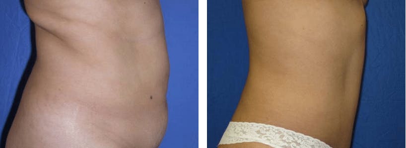 Tummy Tuck Gallery - Patient 74866383 - Image 2