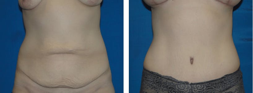 Tummy Tuck Before & After Gallery - Patient 74866384 - Image 1
