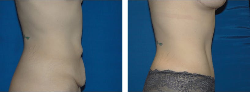 Tummy Tuck Before & After Gallery - Patient 74866384 - Image 2