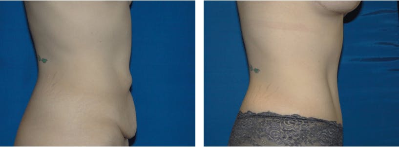 Tummy Tuck Before & After Gallery - Patient 74866385 - Image 2