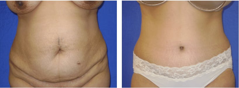 Tummy Tuck Before & After Gallery - Patient 74866386 - Image 1