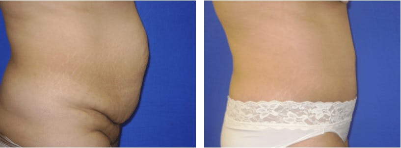 Tummy Tuck Gallery - Patient 74866386 - Image 2