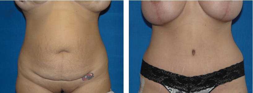 Tummy Tuck Before & After Gallery - Patient 74866387 - Image 1