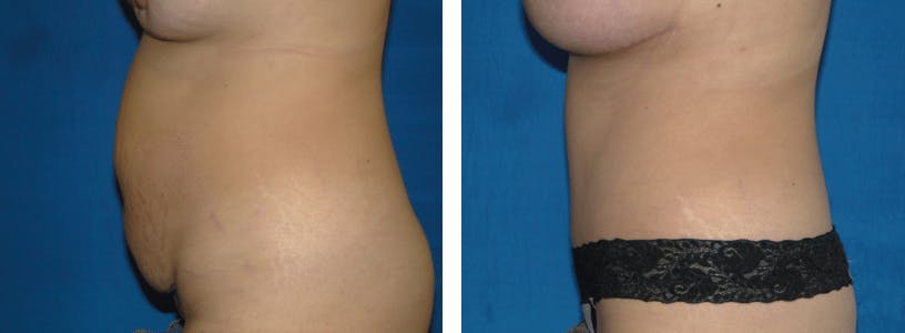 Tummy Tuck Before & After Gallery - Patient 74866387 - Image 2