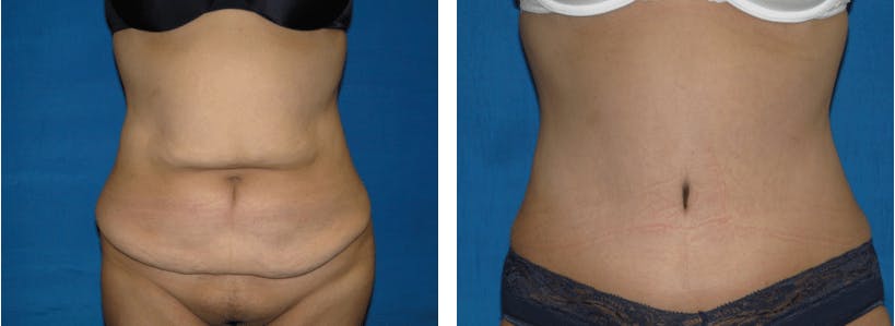 Tummy Tuck Before & After Gallery - Patient 74866388 - Image 1