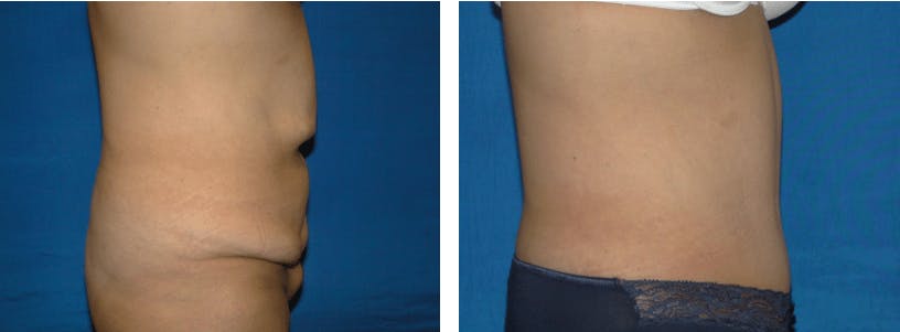 Tummy Tuck Before & After Gallery - Patient 74866388 - Image 2