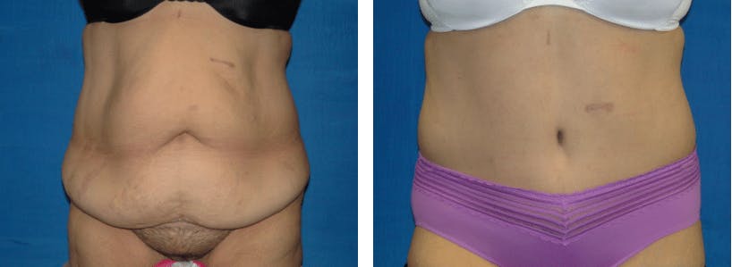 Tummy Tuck Before & After Gallery - Patient 74866389 - Image 1