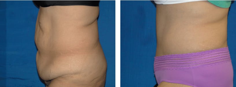 Tummy Tuck Before & After Gallery - Patient 74866389 - Image 2