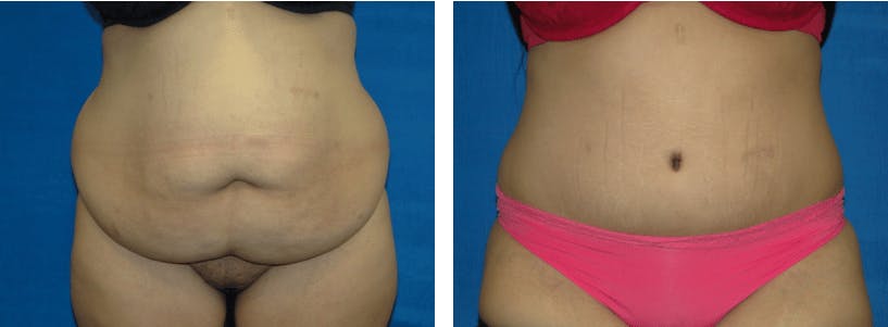Tummy Tuck Before & After Gallery - Patient 74866391 - Image 1