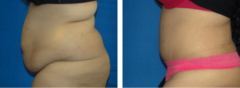 Tummy Tuck Before & After Gallery - Patient 74866391 - Image 2
